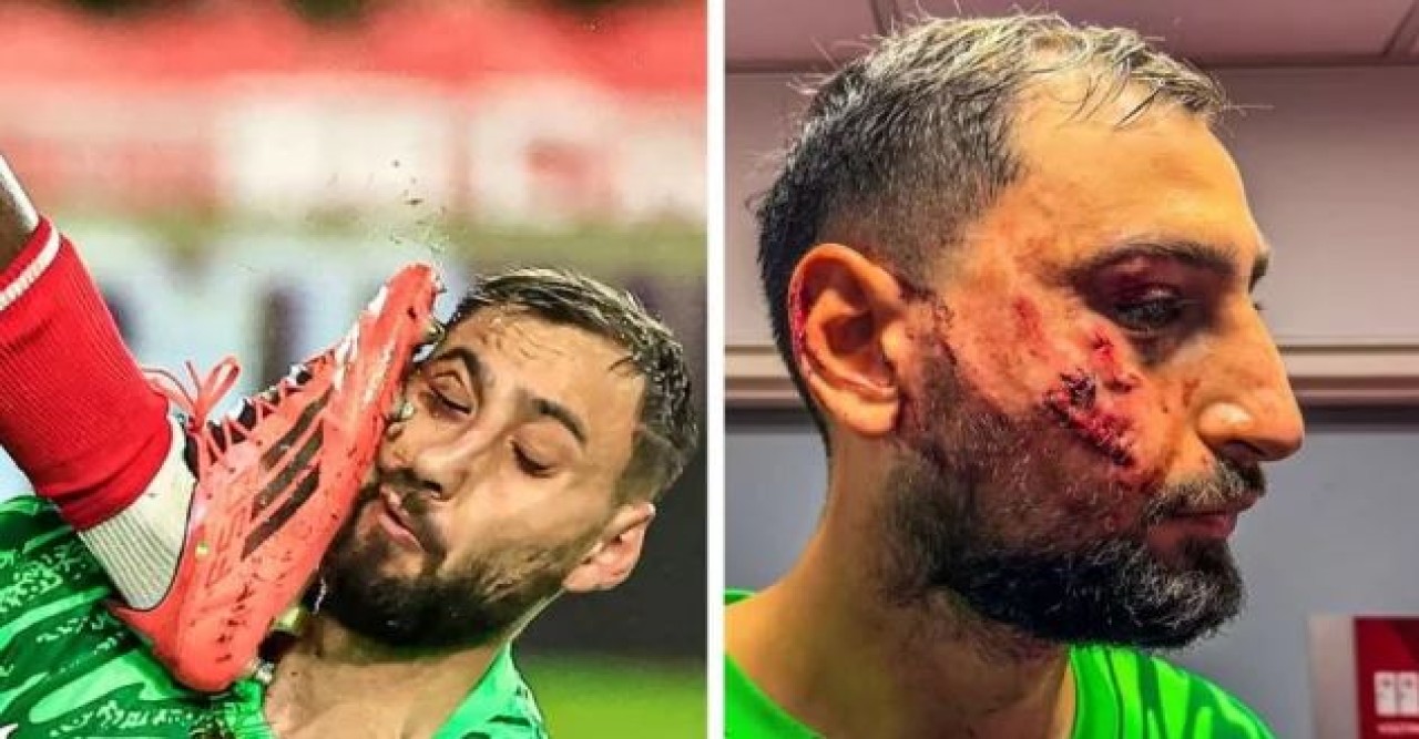 বুটের আঘাতে পিএসজি গোলকিপারের মুখে মারাত্মক জখম